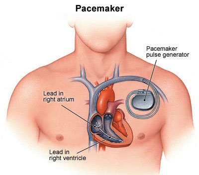 Cardiac Pacemaker 1 - Why Power Lines Bring Bad House Feng Shui